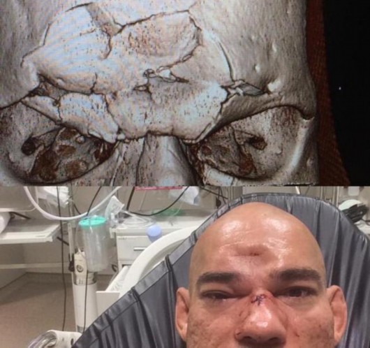 mma机械兽桑托斯遭惨烈ko 一记飞膝致头骨碎裂