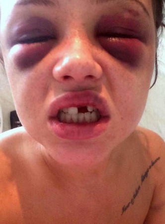 拳手暴打女友被判入狱 打断门牙险毁容